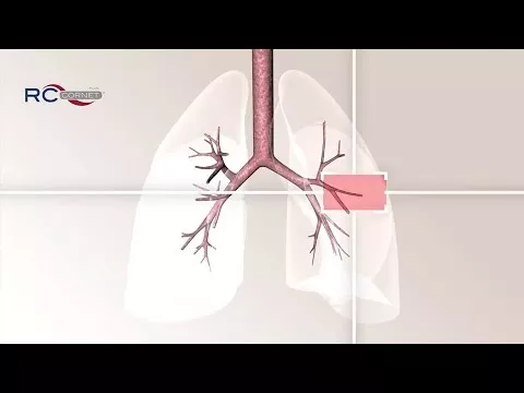 Vídeo sobre RC Corneta Plus, 1 peça